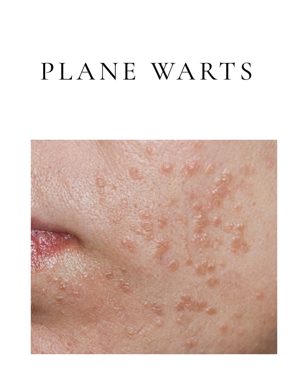 Plane Warts